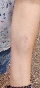 Noticias de Puerto Vallarta | NotiespacioPV | A mordidas, mujer agrede a su ex pareja en Playa Grande