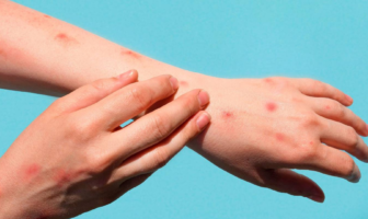 Notiespacio PV | Confirman cinco casos de viruela del mono en Jalisco