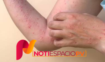 Noticias de Puerto Vallarta | NotiespacioPV | Suman cinco nuevos casos de viruela símica en Jalisco