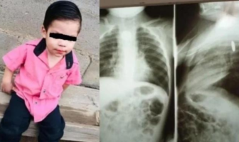 Noticias de Puerto Vallarta | NotiespacioPV | Bebé se traga una pila y se quema el esófago