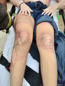 Menor de edad resulta con quemaduras tras flamazo en la colonia San Esteban