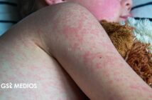 Notiespacio PV | Michoacán reporta la primera muerte por sarampión en 2026