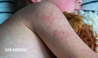 Notiespacio PV | Michoacán reporta la primera muerte por sarampión en 2026